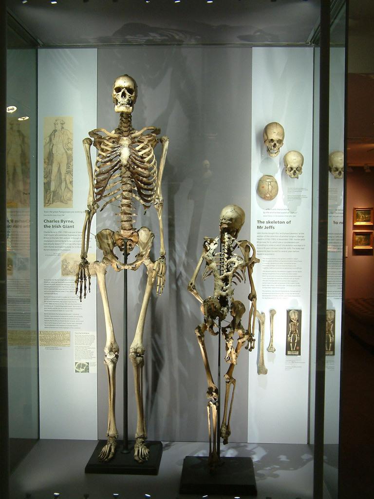 La Chirurgie au Musée Le clou du Musée : The Irish Giant et son pote, l'homme qui se calcifiait.