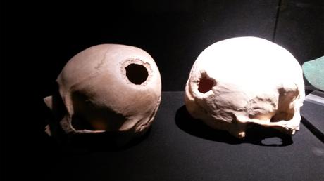 Crânes incas trépanés